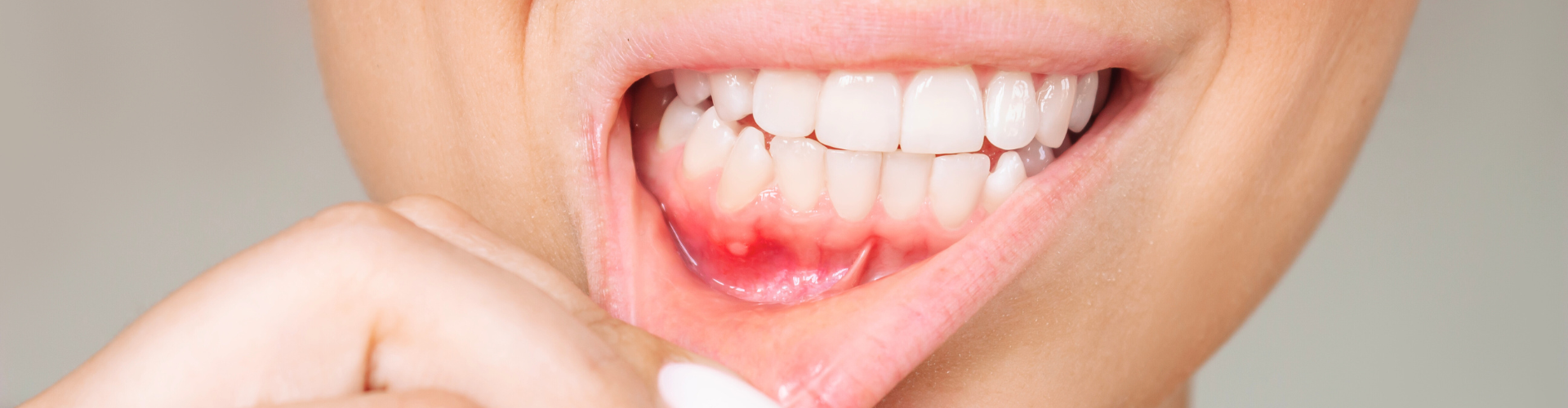 Woman pulling down lower lip to reveal inflamed gums.